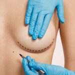 Quel type de chirurgie mammaire devez-vous subir ?
